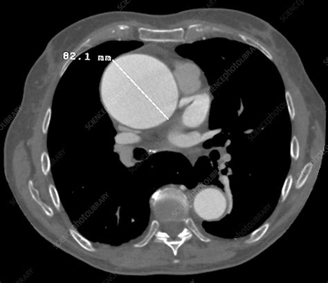 Aortic Aneurysm Ct Scan