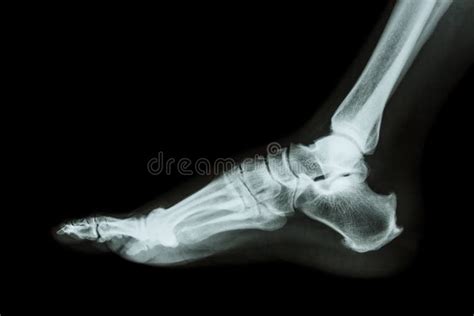 X-ray normal foot lateral stock photo. Image of health - 39502028