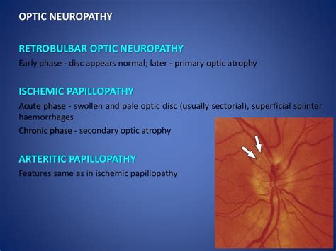 Optic disc evaluation