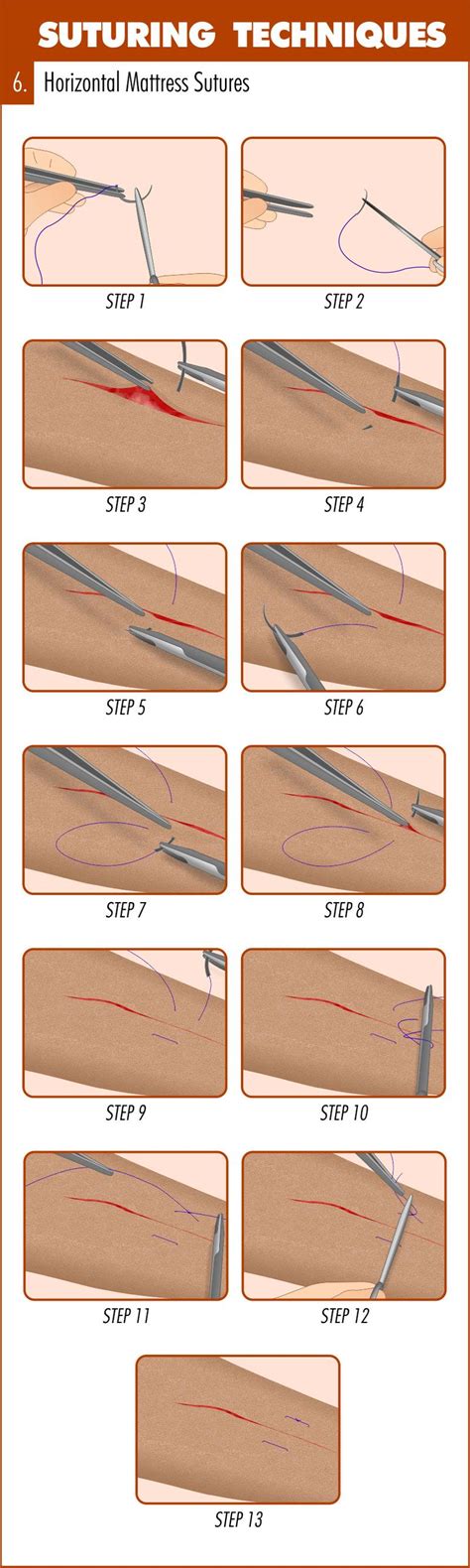 Surgical Suturing Techniques Mastery Guide - The Apprentice Doctor | Suture techniques, Medical ...