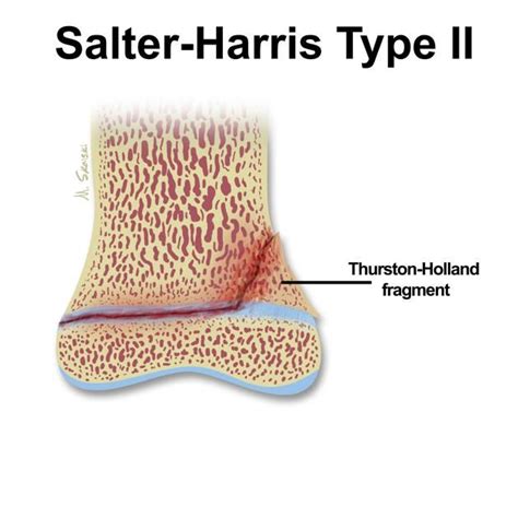 Salter-Harris type 2 fracture - the metaphyseal fragment created between the physis and the ...