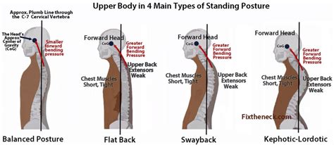 Kyphosis - Causes, Symptoms, Exercises, Surgery, Treatment