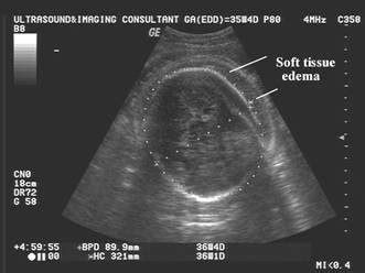 Ultrasound In Fetal Hydrops