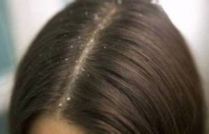 Dandruff and Demodex Mites | Ungex | Demodex Treatment