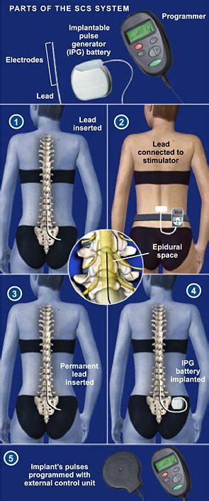 Pin on Surgical Procedures at Southeastern Spine