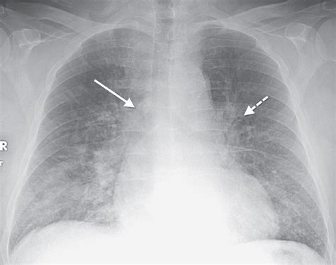 Interstitial Pneumonia X Ray