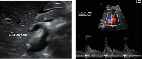 -(A): Ultrasound Abdomen image shows the origin of celiac artery from ...