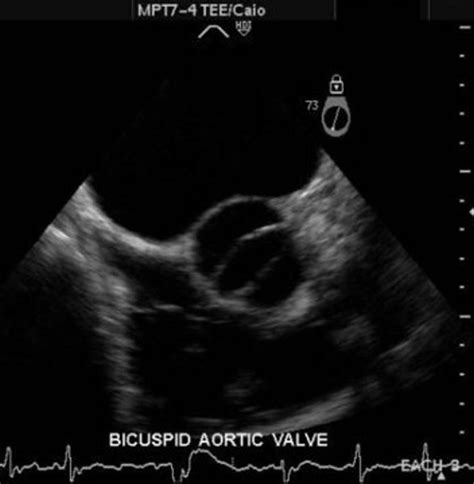 Bicuspid Aortic Valve | Aorta