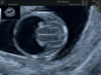 Alobar holoprosencephaly at 12 week gestation | Download Scientific Diagram