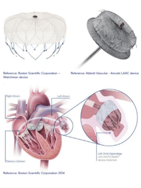 Podcast episode 11: Left Atrial Appendage Closure - HeartHQ | World-class cardiac care ...