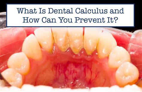 What Is Dental Calculus and How Can You Prevent It? – B.WEISS Water Flosser