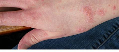 Scabies: Causes, Symptoms, Prevention And Treatment