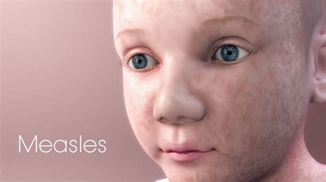 Measles