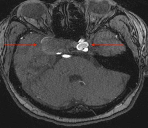 Cureus | Spontaneous Thrombosis of a Giant Cavernous Internal Carotid Artery Aneurysm and Parent ...