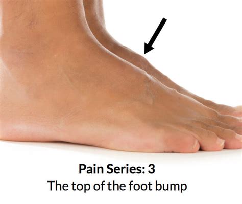 Bone Spur On Top Of Foot In Child - Think You Have A Fractured Toe Here S What Could Happen If ...