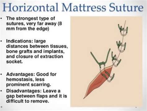 Dr: Mohamed Khadar : Horizontal Mattress Suture | Family conflict, Sutures, Family relationships