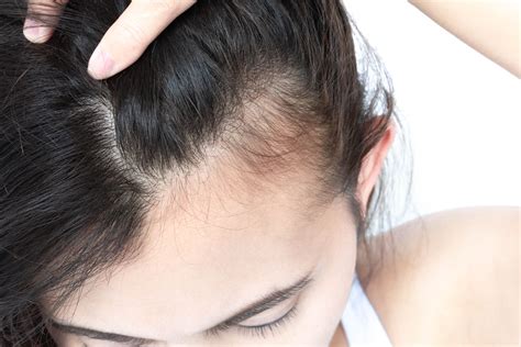 Traction Alopecia - VitalSkin Dermatology