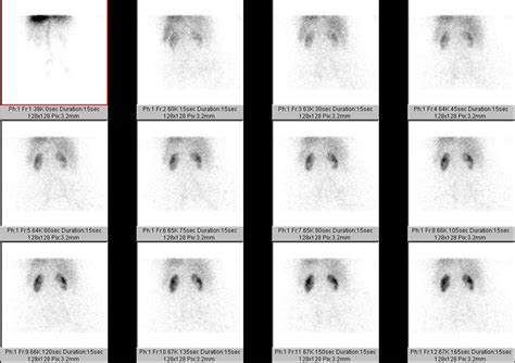 Renal Imaging Patient Education - Brigham and Women's Hospital