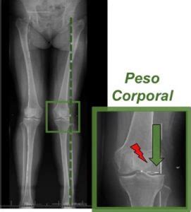 Genu Valgo: Deformidad en “X” de las Rodillas – Juan Arnal ...