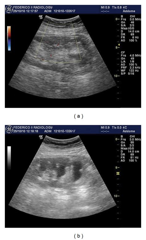 Renal Sinus Ultrasound