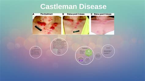 Castleman Disease by Chanise Dixon on Prezi