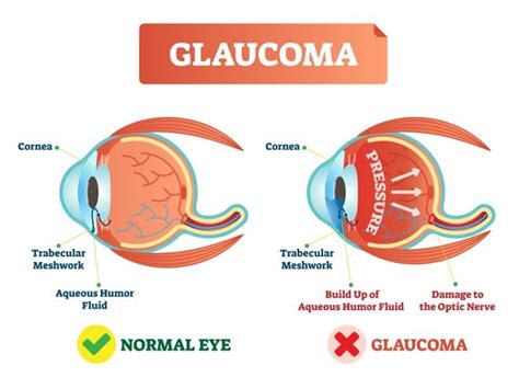 Glaucoma Surgery: Trabeculectomy, Sclerectomy & Ahmed Valve