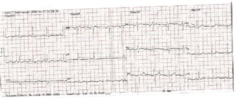 ECG after fibrinolysis showing a return to isoelectric line of ST segment. | Download Scientific ...