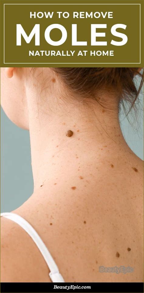 How to Get Rid of Moles Naturally? | Mole removal, Mole removal at home ...