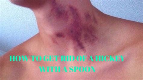 how to get rid of a hickey with a spoon - YouTube