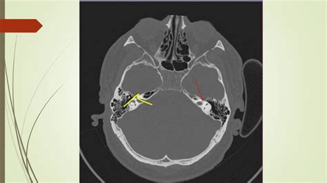 Ct scan temporal bone Dr Zeeshan Ahmad