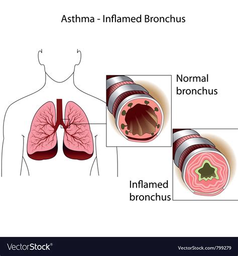 Bronchial tubes of healthy person and a person suf