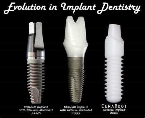 Ceramic Dental Implants - Brooklin, Whitby, Oshawa Ontario Dentists