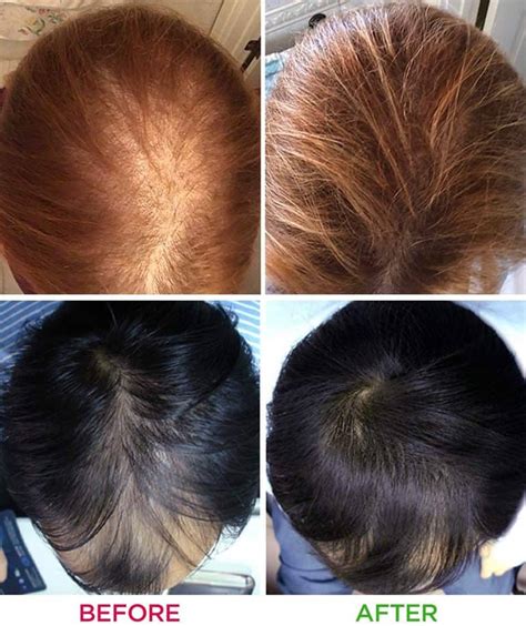 Red Laser Light For Hair Growth: What Is It And Does It Work? - Woman and Wellness