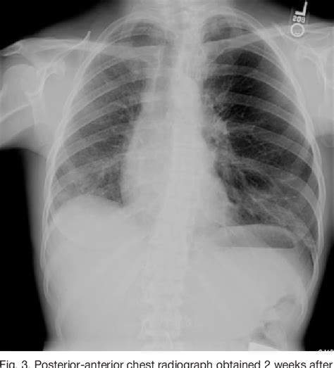 Figure 3 from Typical Symptoms and Atypical Radiographic Findings in a ...