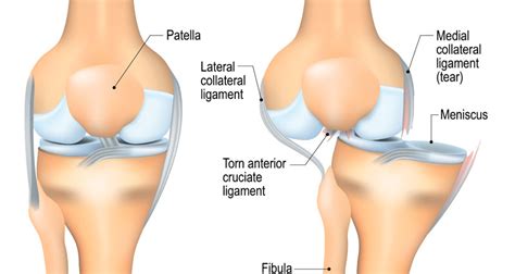 Dislocated Knee - Symptoms, Causes & Treatment