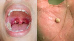 How Do You Know if You Have Tonsil Stones?