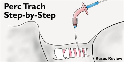 Tracheostomy Procedure Anatomy