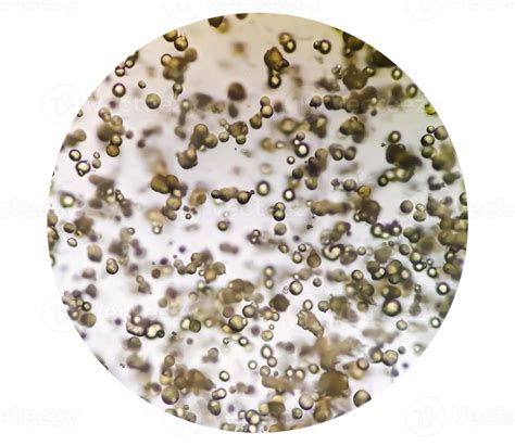 Microscopic image of Urinalysis. Abnormal urine exam. Uric acid crystals. 13675248 Stock Photo ...