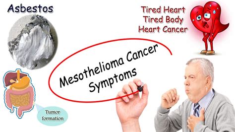 Mesothelioma cancer symptoms | moonlightforall.com