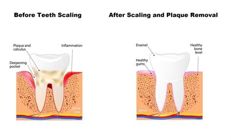 What does teeth scaling do?