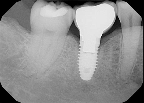 Dental X-ray Safety Facts | Penn Dental Medicine