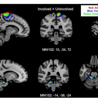 FIGURE E (A) Shows sensorimotor strip brain activity from the involved... | Download Scientific ...