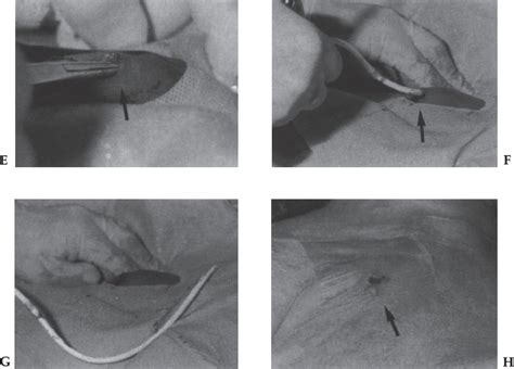 Catheter and Port Removal: Techniques and Follow-Up Care | Thoracic Key