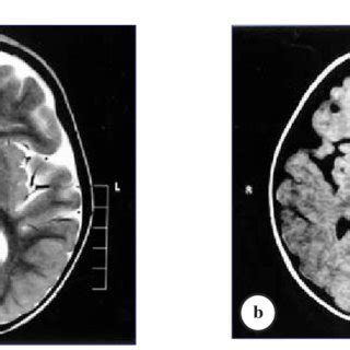 (PDF) Magnetic resonance imaging of the brain in children with chronic ...