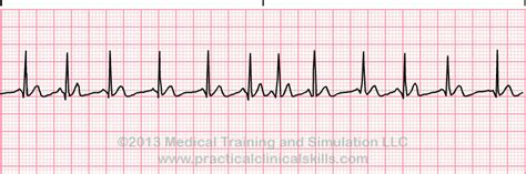 Atrial Rhythms ECG Interpretation