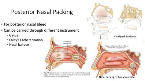 Epistaxis