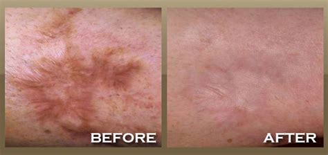 Skinpeccable | Scar Removal | Los Angeles