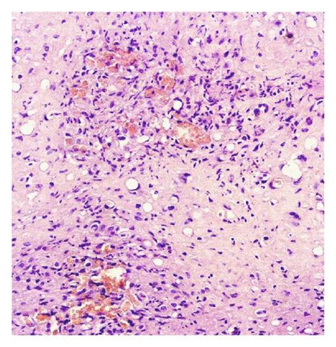 (a) Abdominal computed tomography showing an hypodense lesion in the... | Download Scientific ...