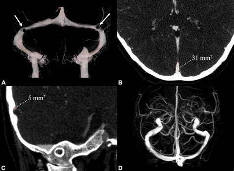 Transverse Sinus Mri