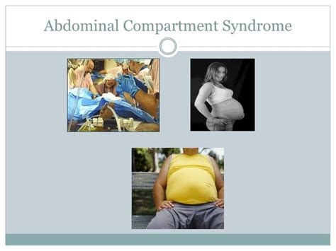 PPT - Abdominal Compartment Syndrome PowerPoint Presentation - ID:3316849